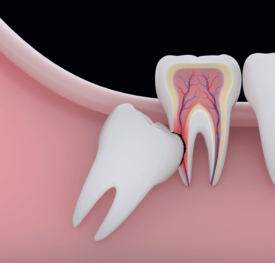 Удаление ретинированных зубов мудрости